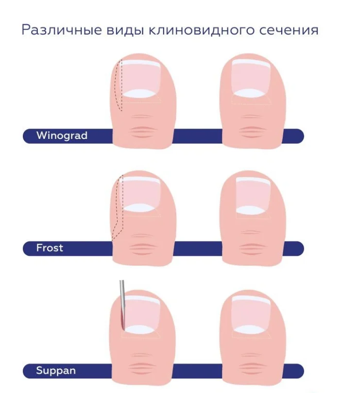 Лечение вросшего ногтя